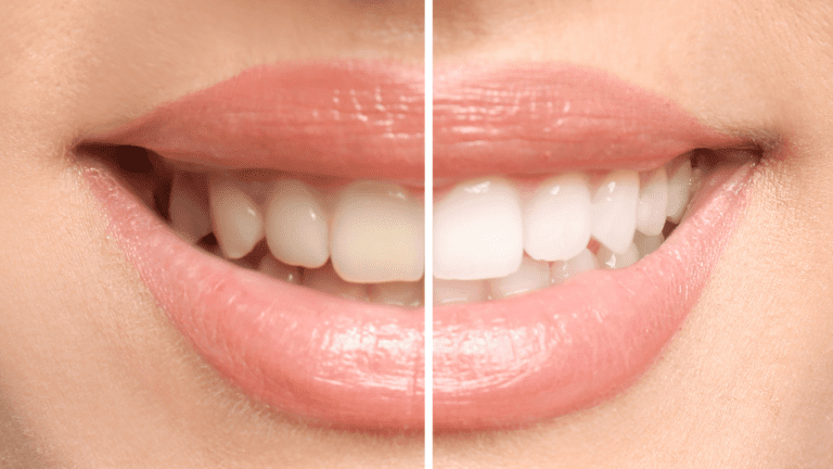 Analyzing The Risks Of Online Marketing For Teeth Whitening Products,