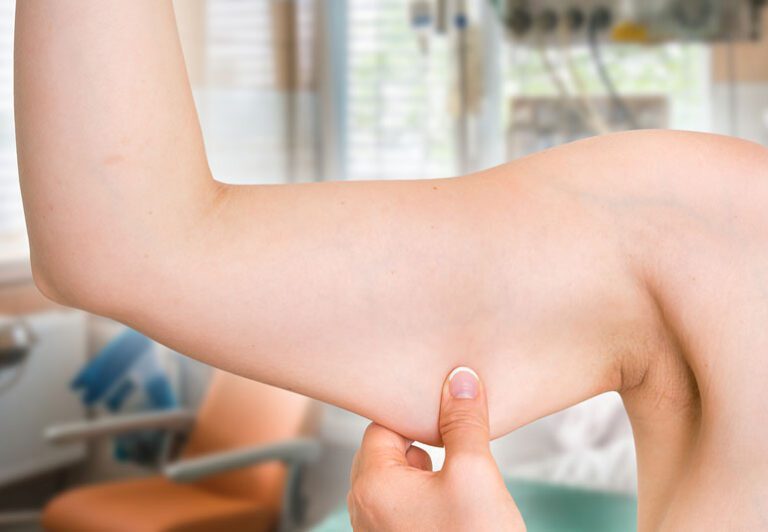 Are You Considering Arm Lift Surgery? Facts You Need To
