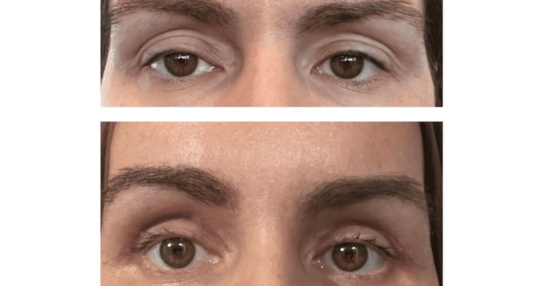 Brow Lift Surgery Not Yet A Lost Art | Health