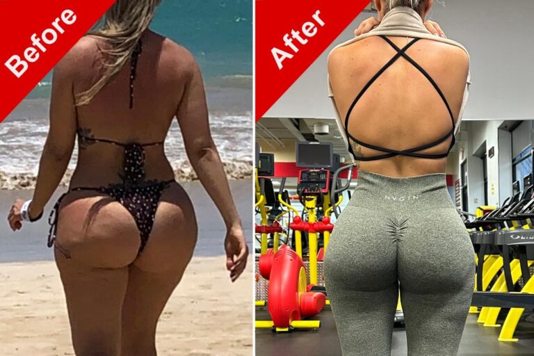 I Hated My Brazilian Butt Lift — And Paid $25,000