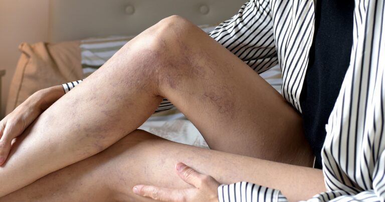 Varicose Vein Treatments, According To A Doctor