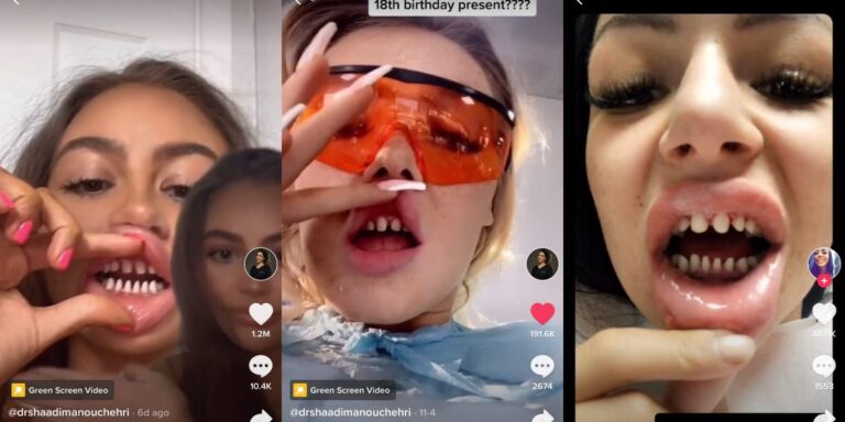 Dentists Say Influencers With Crowns Will Need Dentures By Age