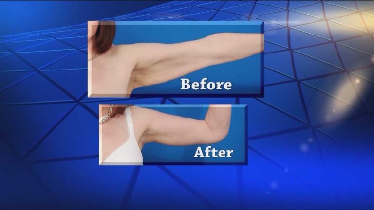Do You Have A Flap On The Upper Arm? Brachioplasty