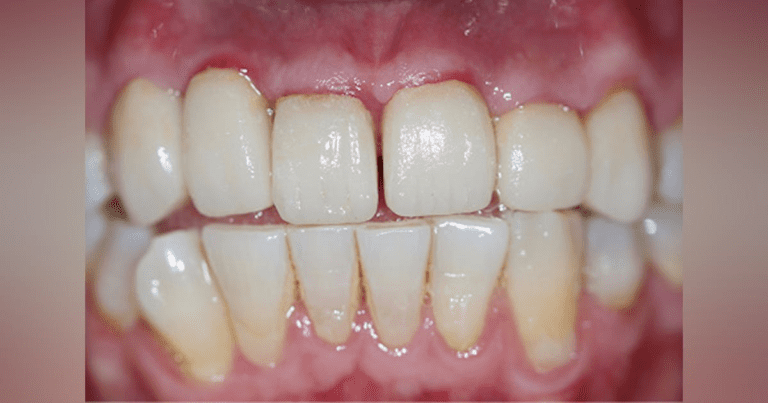 Impressions And Temporaries: A Simplified Method For Crown And Bridge