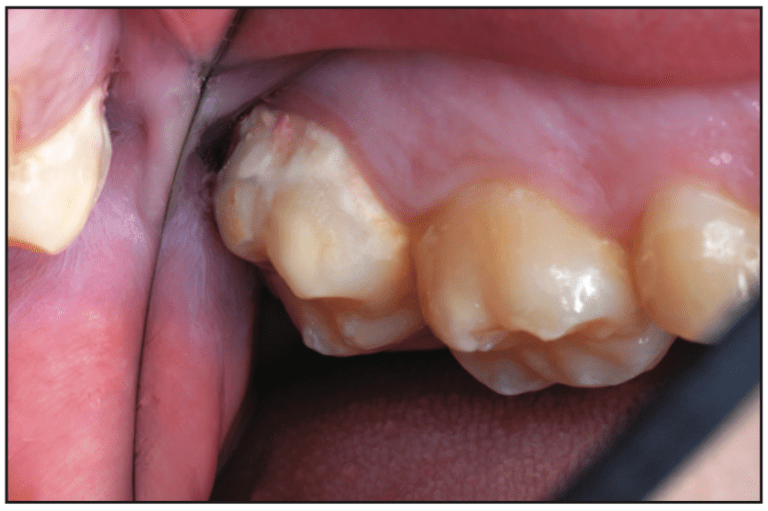 Smooth Caries And Decalcification Surface: Application Of Restoration And Reinforced