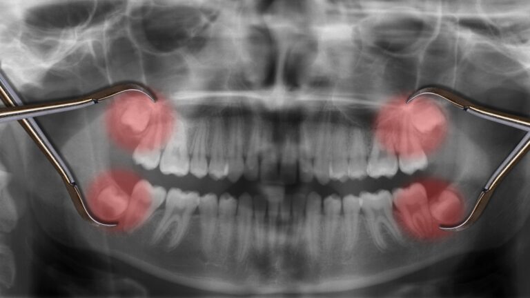 Wisdom Teeth Complications: Causes And Treatment Options