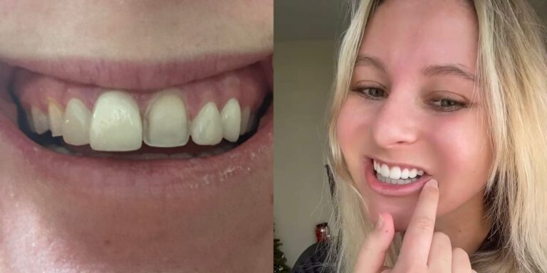 Woman Describes Failed Veneer Procedure, False Teeth That Fell Out