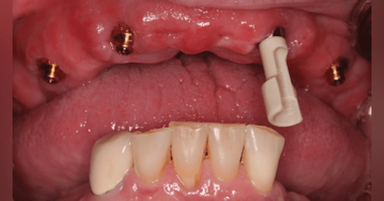 10 Tips For Long Term Success Of Implant Retained Removable Dentures