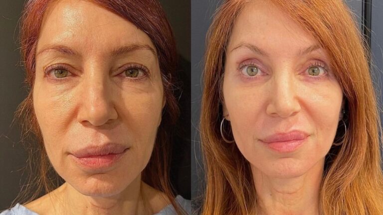 Blepharoplasty: The Eyelid Lift Procedure Is On The Rise —