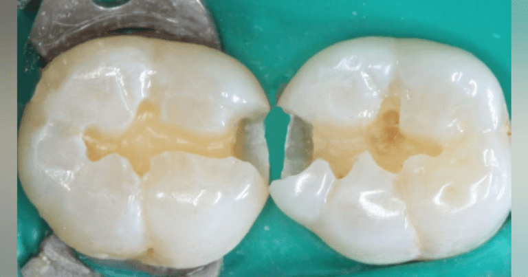 Obtaining Optimal Retention For Dental Restorations