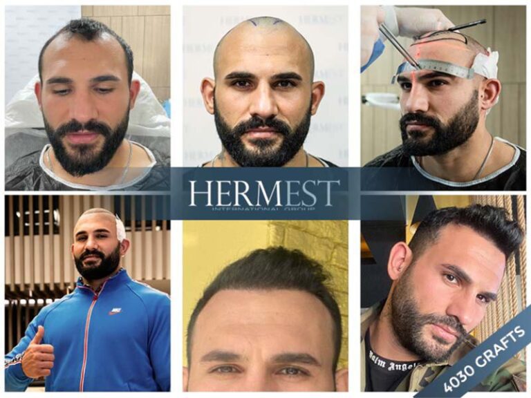 The Best 11 Hair Transplant Clinics In Turkey: Everything You