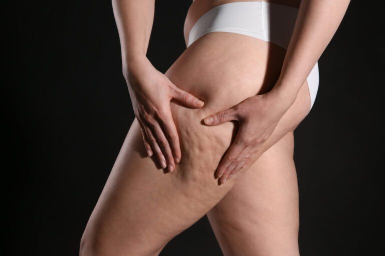 Cellulite Treatments Make Big Promises—but Few Actually Deliver