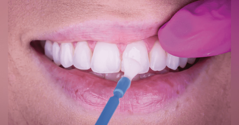 Fluoride Varnishes: What's The Difference And Which Is Best?