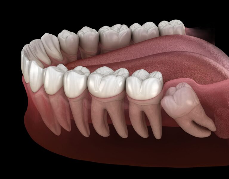 Molars And Wisdom Teeth: Function And Problems