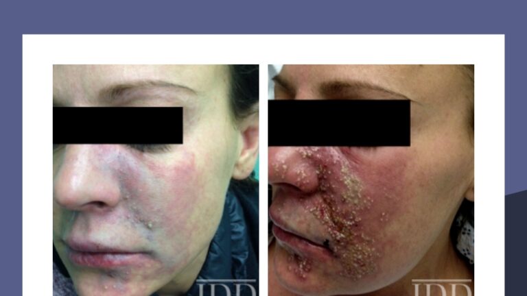 The Hidden Dangers Of Facial Filler Injections: Serious Vascular Complications