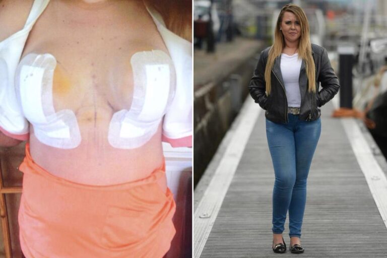 A Woman's Nipples Die And Fall Off After Botched Plastic