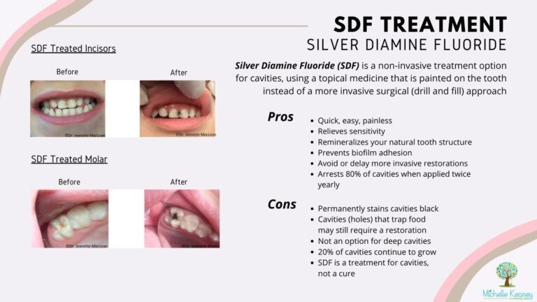 Silver Diamine Fluoride Matches Sealants In Cavity Prevention