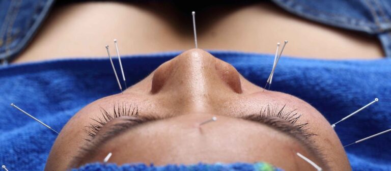 Acupuncture For Your Face. Yes, It's A Thing, And It's