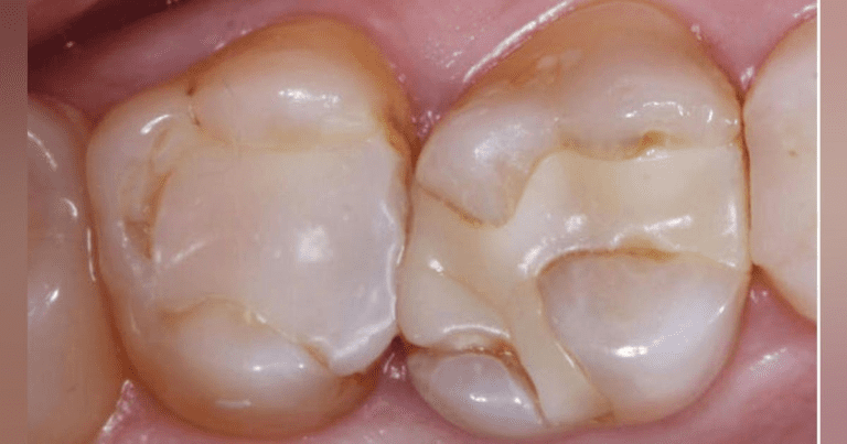 Reduction Of Recurrent Caries In Composite Restorations