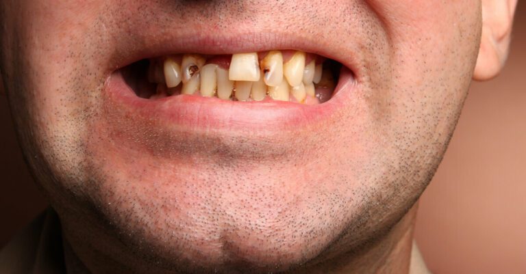 Wales Increases Nhs Dental Fees
