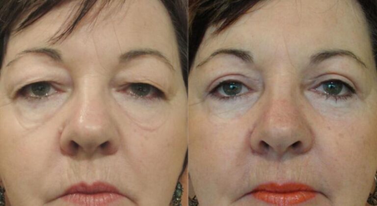 The Blepharoplasty Market Will Reach A New Level Next Year