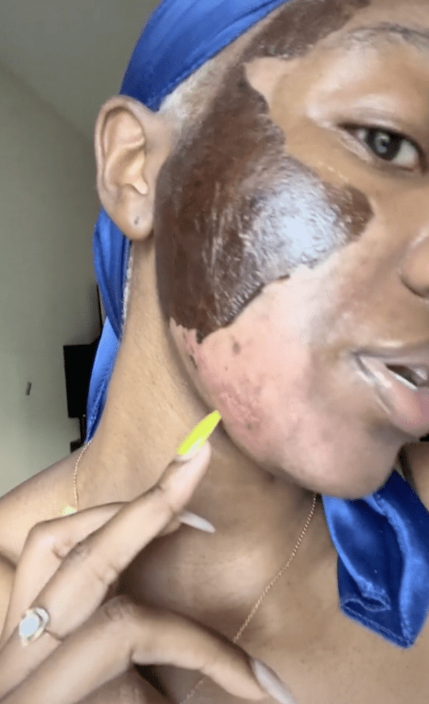 This Terrifying Result Shows The Dangers Of A Chemical Peel