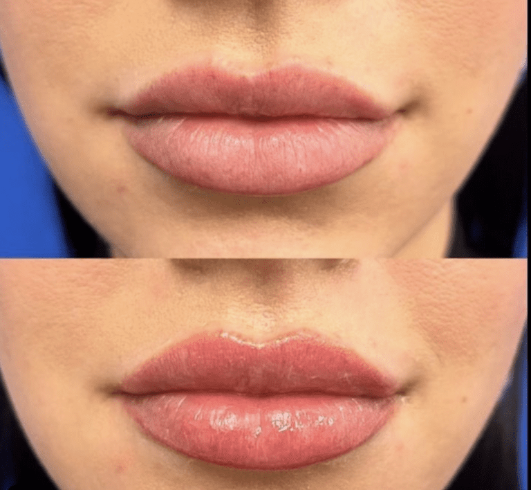 "laser Lip Fiip" Is The New, Needle Free Way To Fill