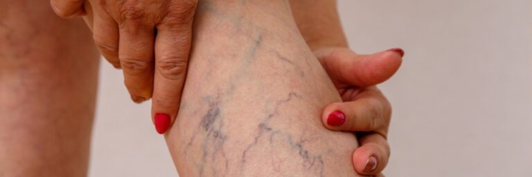 Laser Therapy Is The Preferred Treatment For Troublesome Varicose Veins