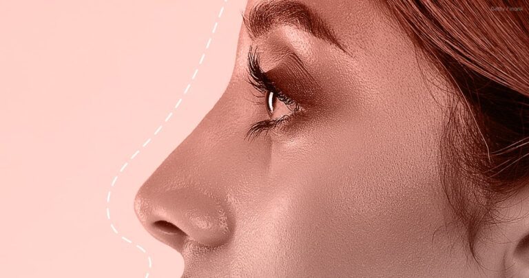 "tip Lift" Nose Job Procedure: Recovery, Before And After