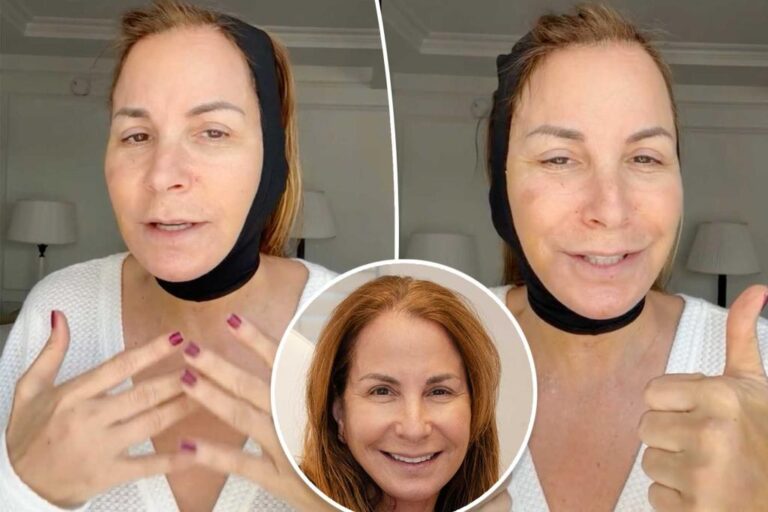 All The Details On Jill Zarin's Facelift: See The Initial