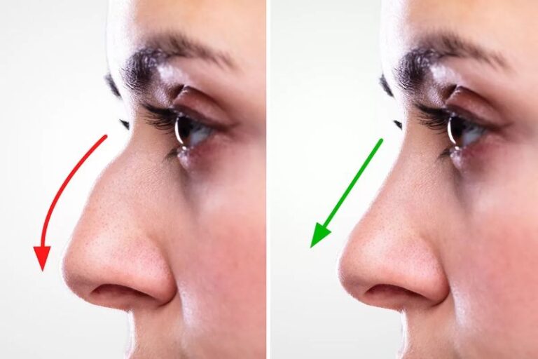 Rhinoplasty Market Projected To Witness Substantial Growth, 2024 2031: Stryker Corporation,