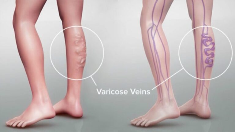 Buy Varicose Vein Treatment