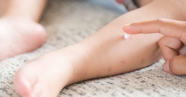 Chicken Pox Scar Removal: Treatments And Home Remedies