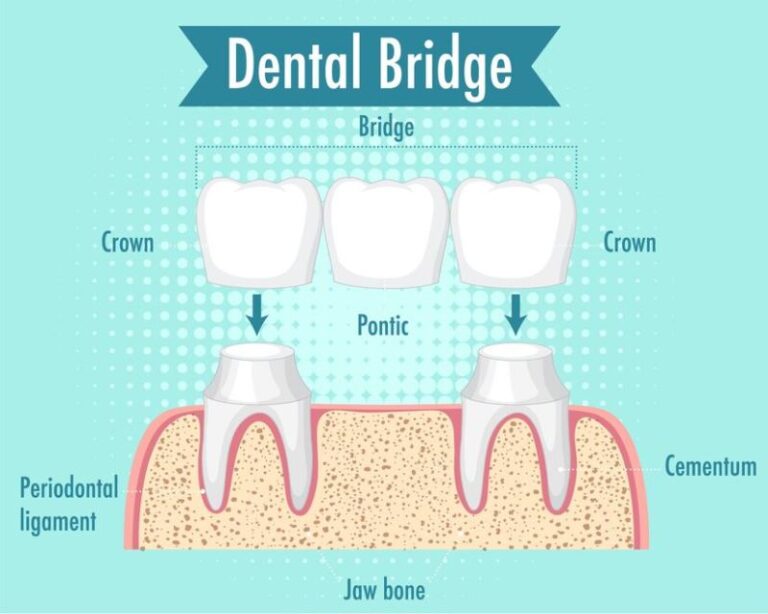 Market Size, Trends, Growth, Crowns And Bridges,