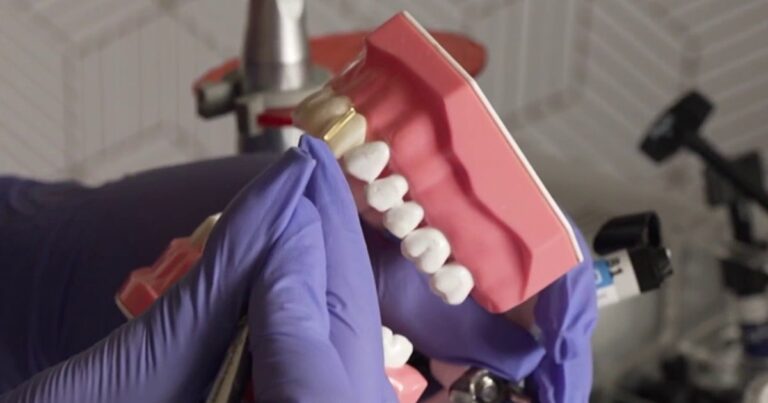 The Former "veneer Technology" Warns Against Illegal Dental Procedures