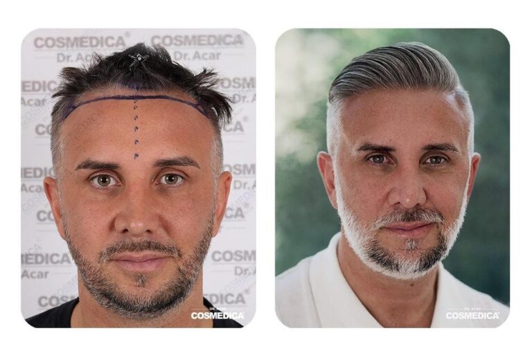 Why Celebrities Choose To Have A Hair Transplant In Turkey