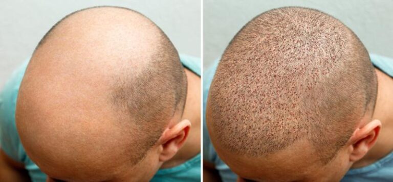 The Hair Transplant Market Is Expecting Huge Demand In The