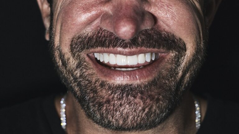 Why Does Everyone Have Veneers Now?